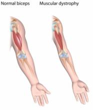 Le déflazacort, un glucocorticoïde utilisé comme anti-inflammatoire et immunosuppresseur est reconnu comme un traitement sûr